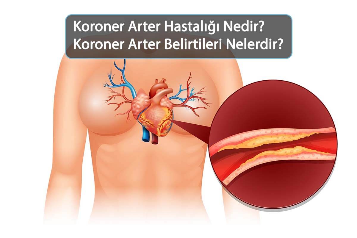Koroner Arter Hastalığında Hayati Riskler ve Kesin Önlemler [2026] - Kapak Görseli